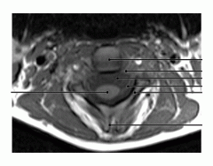 Cervical Vertebrae Axial Image