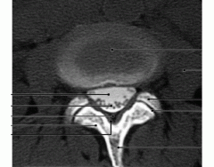 Lumbar Vertebra Axial MRI image
