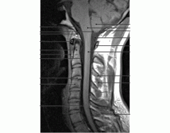 Cervical Vertebra Sagital MRI Image
