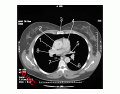 Heart and related vessels (Axial CT Chest 4 of 5)