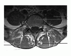 Lumbar Vertebra Axial MRI image T1