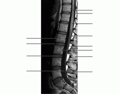 Lumbar Vertebra Sagital MRI image