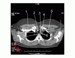 Heart and related vessels (Axial CT Chest 1 of 5)