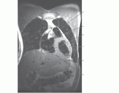 Coronal MRI of the Heart 2