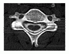 Cervical Vertebra Axial MRI Image