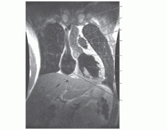 Coronal MRI of the heart