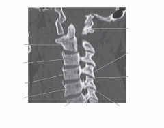 Cervical Vertebra CT Sagital Image 2