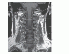 Cervical Vertebra Coronal Image
