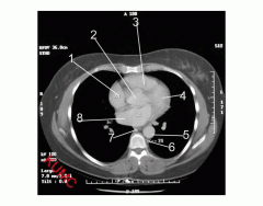 Heart and related vessels (Axial CT Chest 5 of 5)