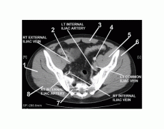 Pelvis (CT Axial Soft Tissue 7 of 14)