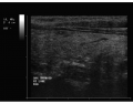 Thyroid Ultrasound 2