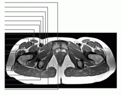 Pelvis (MRI Axial 3 of 4)