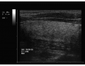 Thyroid Ultrasound 12