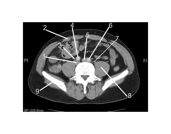 Pelvis (CT Axial Soft Tissue 2 of 14) Quiz