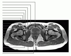 Pelvis (MRI Axial 2 of 4)