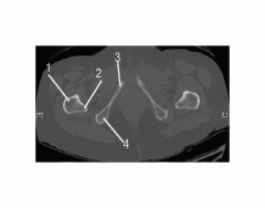 Pelvis (CT Bone Axial 9 of 10)