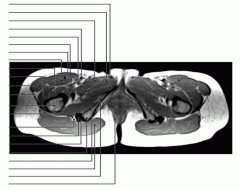 Pelvis (MRI Axial 4 of 4)