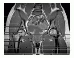 Pelvis (MRI Coronal 2 of 2)