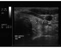 Thyroid Ultrasound 14