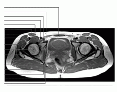 Pelvis (MRI Axial 1 of 4)