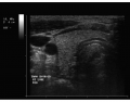 Thyroid Ultrasound 7
