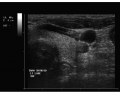 Thyroid Ultrasound 16