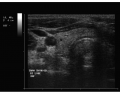 Thyroid Ultrasound 8