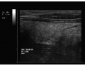 Thyroid Ultrasound 4