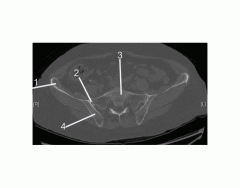 Pelvis (CT Bone Axial 2 of 10)