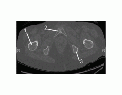 Pelvis (CT Bone Axial 8 of 10)