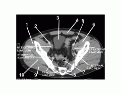 Pelvis (CT Axial Soft Tissue 8 of 14)