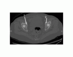 Pelvis (CT Bone Axial 3 of 10)