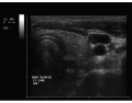 Thyroid Ultrasound 13