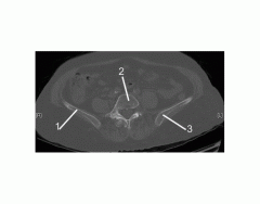 Pelvis (CT Bone Axial 1 of 10)