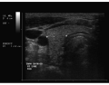Thyroid Ultrasound 6
