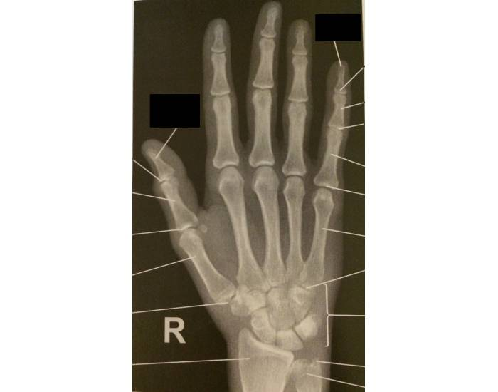 Fig. 4 - 22 PA Hand Projection Quiz