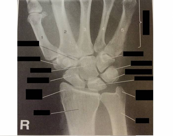 Fig. 4-29 PA Wrist Projection Quiz