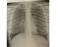 Figure 3-19 PA Chest Projection