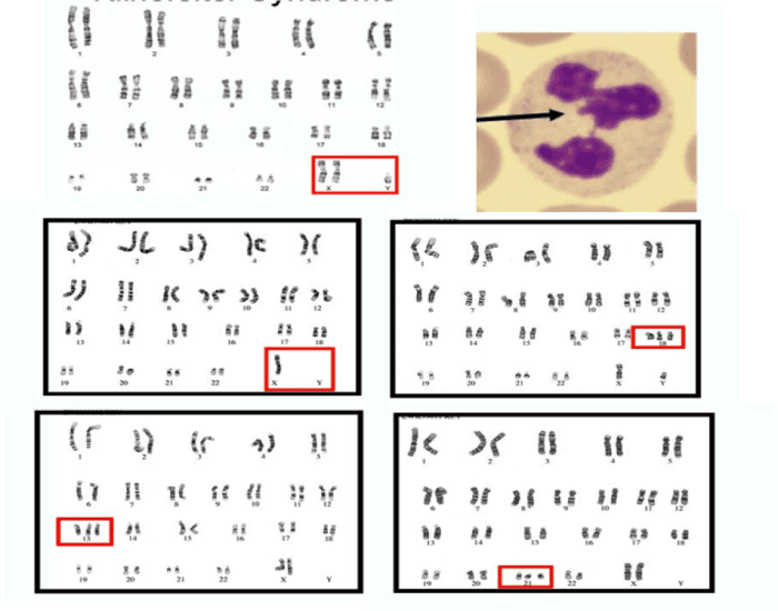 genetics-karyotype-pathologies-and-barr-body-printable-worksheet