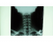 Cervical Spine A-P Xray