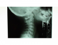 Lateral Neck Xray