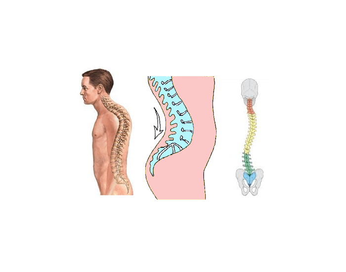 Spinal Defet Label the Spinal Defect Quiz