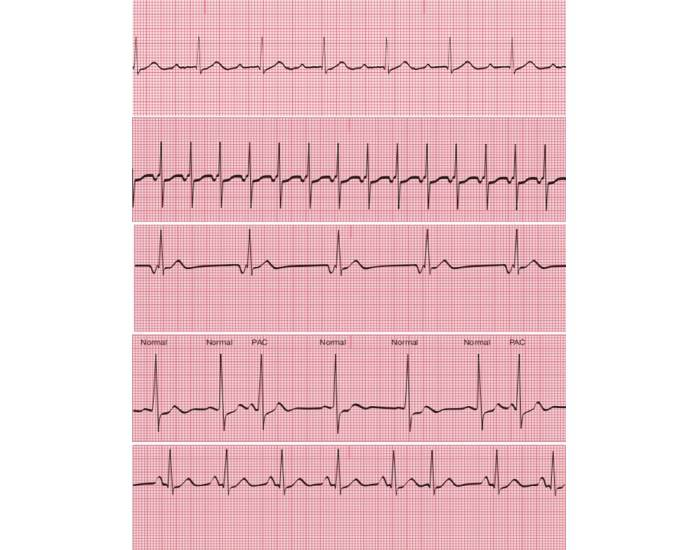 Random Ecg Ekg Rhythm Game , ECG Quiz – NHNJWI