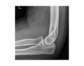 Lateral Elbow Radiograph