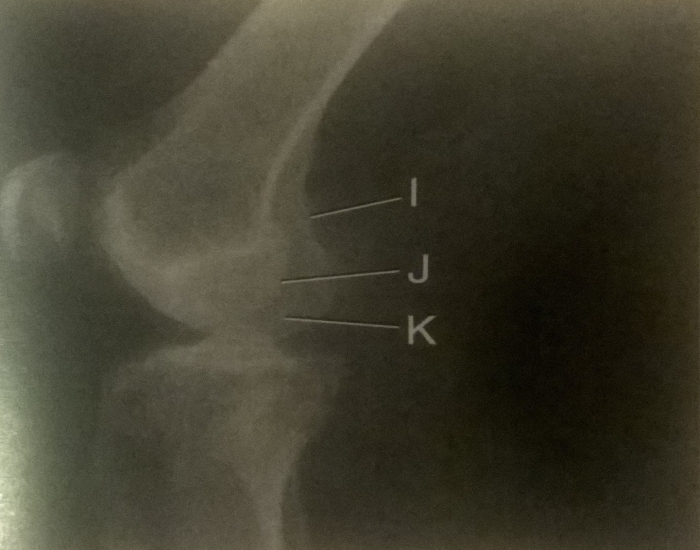 Rotated lateral knee medial condyle more posterior Quiz