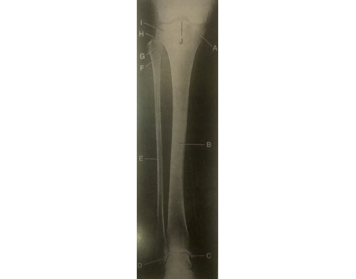 AP tibia and fibula radiograph Quiz