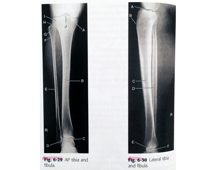 AP & Lateral Tib/Fib Quiz