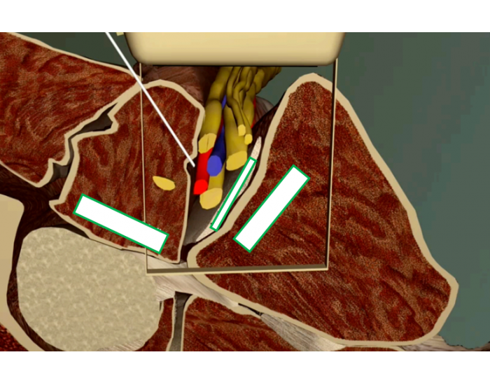 Axillary Block: In-Plane Approach Quiz