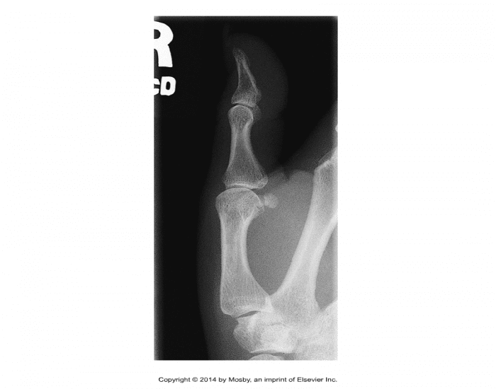 Lateral Thumb Rotation Lateral Thumb Radiograph Quiz