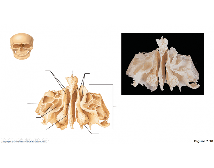 Ethmoid Bone Quiz